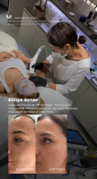 Ellisys Sense by Dr.Tuiana