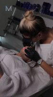Endolift® and Morpheus8 combined protocol by Dr. Milena