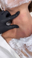 Morpheus8® - Morpheus-Liliia-Patient