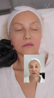 Endolift® by Dr. Milena: Before