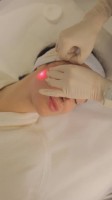 Endolift®